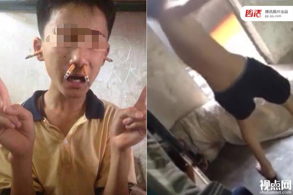 2015年6月29日,在广东从化读初二的小亮遭同宿舍的6名男生用烟头插在鼻孔和耳孔。母亲将图片发给班主任反映后,次日被叫到学校,竟发现智力障碍的儿子不仅遭同学插烟头戏弄,更被人用被子包裹放倒在地,用木棍抽打。
