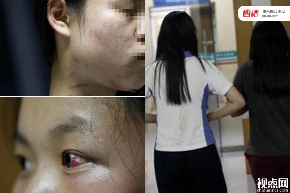 当“私了”“转学”成为解决暴力事件的潜规则之时,不仅对于受害者而言非常不公平,也未能杜绝暴力行为、让其他学生免于被暴力的危险。图为2016年9月26日中午,深圳中嘉职业技术学校15岁的女生小雨(化名)在宿舍内被5名女同学围住,对方称其偷钱,小雨否认,后来有3名女生动手打她耳光,踹肚子和身上其他地方,导致全身多处存在淤青,左眼充血,走起路来也一瘸一拐的。小雨称后来自己承认了,但只是怕对方继续打自己。事后,3名打人的女同学和家长到医院看望小雨,并进行道歉。