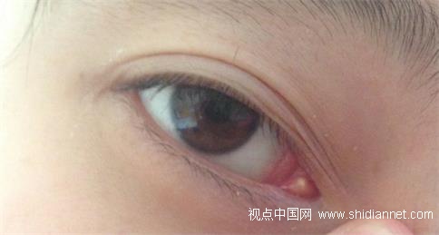 男子长期戴隐形致眼化脓:以为半年抛是半年不取