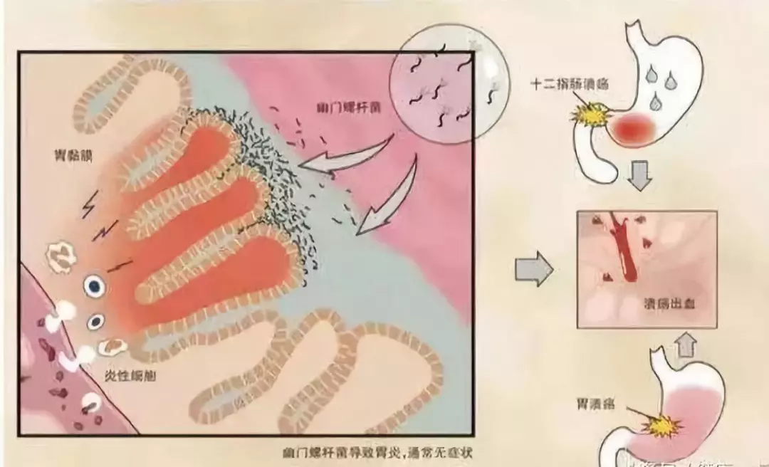 武汉一家七口集体失眠 竟因都感染了这个Ⅰ类致癌物