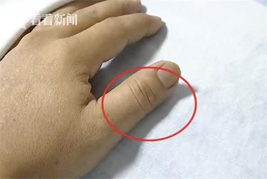 厨师徒手切猪肉被割伤 感染猪链球菌差点丧命