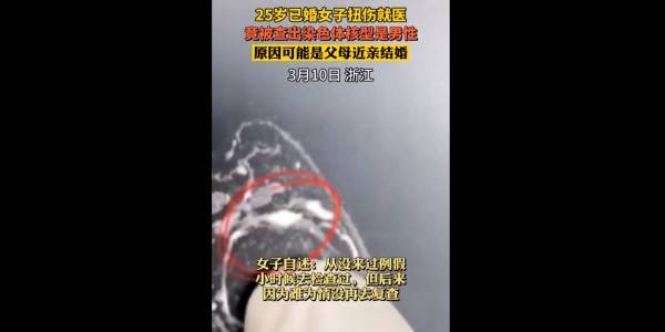 因脚踝扭伤就医，25岁已婚女子被查出染色体核型是男性